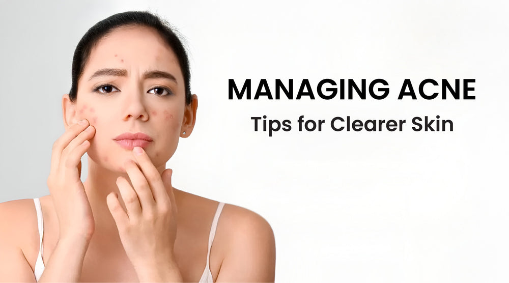 Managing Acne: Tips for Clearer Skin and a Happier Life
